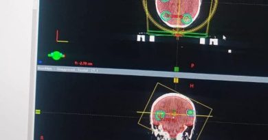 ‎MTRH Conducts its First Stereotactic Radiosurgery (SRS)
